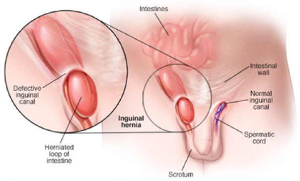 HERNIA INGUINAL
